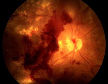 Diabetic Retinopathy